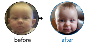 Before-and-after EarBuddies Stick-Out Ears result; started at 3–6 months – Melissa & Baby Emilia