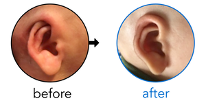 Before-and-after EarBuddies Cryptotia result; started within the first month – Gabriela & her Son Sebastián