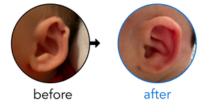 Before-and-after EarBuddies Rim Kink result; started within the first month – Sydney & her Daughter Ava
