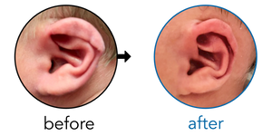 Before-and-after EarBuddies Rim Kink result; started within the first month – Matt, Jess, & their son Zeph