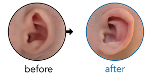 Before-and-after EarBuddies Cup Ear result; started at 1–3 months – Laura & her daughter Erin