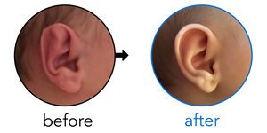 Before-and-after EarBuddies Stahl's Bar result; started within the first month – Anne & her Daughter