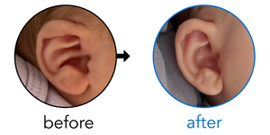 Before-and-after EarBuddies Conchal Crus result; started within the first month – Stephanie, Matt & their Daughter Molly