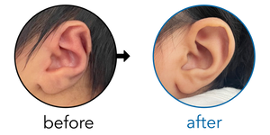 Before-and-after EarBuddies Stahl's Bar result; started at 3–6 months – Sofia & her daughter Imaan