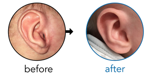 Before-and-after EarBuddies Conchal Crus result; started within the first month – Olivia & her Baby