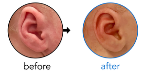 Before-and-after EarBuddies Folded-Over Helical Rim result; started within the first month – Alexandra & her son