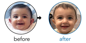 Before-and-after EarBuddies Stick-Out Ears result; started at 3–6 months – Tajanpreet & her Daughter