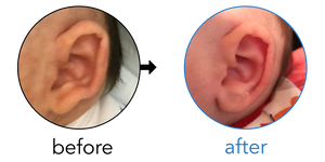 Before-and-after EarBuddies Stick-Out Lobe result; started at 1–3 months – Amy & her Daughter Celina