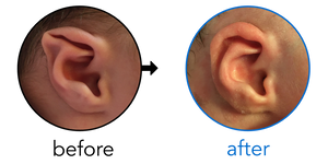 Before-and-after EarBuddies Stahl's Bar result; started within the first month – Liza, Oli & their Daughter Yvette