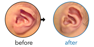 Before-and-after EarBuddies Lop Ear result; started within the first month – Elwyn & his son Emrys