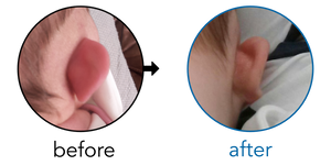 Before-and-after EarBuddies Stick-Out Ears result; started within the first month – Mr. H & his Daughter Scarlett