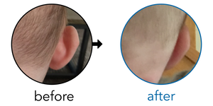 Before-and-after EarBuddies Stick-Out Ears result; started at 1–3 months – Simone M & her Baby Daughter