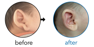 Before-and-after EarBuddies Stick-Out Lobe result; started at 1–3 months – Anna & her Son Connor
