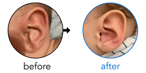 Before-and-after EarBuddies Conchal Crus result; started at 3–6 months – Brianna, Jake & their Son Bronny