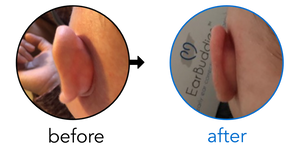 Before-and-after EarBuddies Stick-Out Ears result; started at 1–3 months – Amy & her Son Jacob