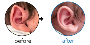 Before-and-after EarBuddies Folded-Over Helical Rim result; started within the first month – Danielle & her son