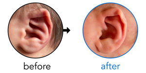 Before-and-after EarBuddies Conchal Crus result; started within the first month – Rebecca & her Son