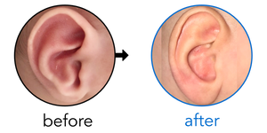 Before-and-after EarBuddies Conchal Crus result; started within the first month – Leora & her son Idan