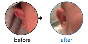 Before-and-after EarBuddies Stick-Out Ears result; started within the first month – Amy & her Son