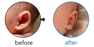 Before-and-after EarBuddies Stick-Out Ears result; started within the first month – Hayley & her Son Reggie