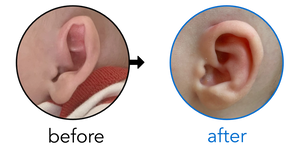 Before-and-after EarBuddies Stick-Out Ears result; started within the first month – Cristina & her Daughter