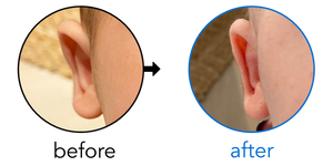 Before-and-after EarBuddies Stick-Out Ears result; started within the first month – Rachael & her son Adam