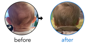Before-and-after EarBuddies Stick-Out Ears result; started at 1–3 months – Magdalena & her son Oscar