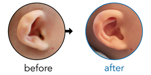 Before-and-after EarBuddies Cup Ear result; started at 1–3 months – Mrs. C & her Daughter Olivia