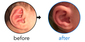 Before-and-after EarBuddies Conchal Crus result; started within the first month – Brittany, Jeremiah & their Daughter