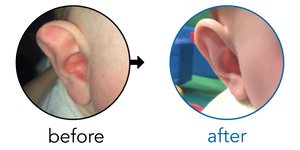 Before-and-after EarBuddies Stahl's Bar result; started at 3–6 months – Sarah P & Baby Harry