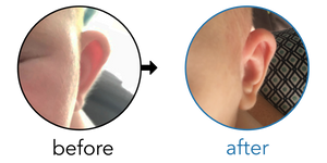 Before-and-after EarBuddies Stick-Out Ears result; started at 1–3 months – Jo & her Daughter Ettie