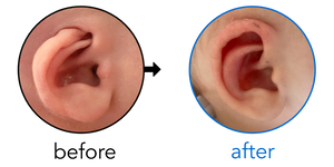 Before-and-after EarBuddies Cryptotia result; started within the first month – Caroline, Tom & their Son