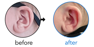 Before-and-after EarBuddies Conchal Crus result; started at 3–6 months – Lauren & her son