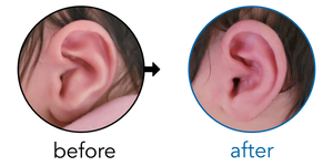 Before-and-after EarBuddies Conchal Crus result; started at 1–3 months – Cassidy & her daughter