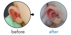 Before-and-after EarBuddies Stick-Out Ears result; started at 1–3 months – Elyse & her Daughter