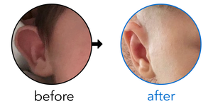 Before-and-after EarBuddies Stick-Out Ears result; started within the first month – Emma & her Daughter Polly