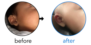 Before-and-after EarBuddies Stick-Out Ears result; started at 3–6 months – Doris & her Son Jacob