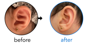 Before-and-after EarBuddies Conchal Crus result; started at 1–3 months – Jeffry, Judy & their Daughter Alaia Lucia
