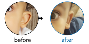 Before-and-after EarBuddies Stick-Out Ears result; started at 6–12 months – Annabel & her Son