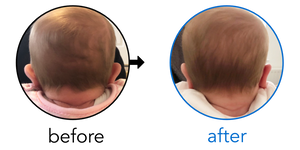 Before-and-after EarBuddies Stick-Out Ears result; started within the first month – Emily & her Daughter Olivia