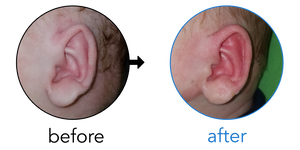 Before-and-after EarBuddies Folded-Over Helical Rim result; started at 1–3 months – Jacquelyn & her Son