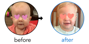 Before-and-after EarBuddies Stick-Out Ears result; started at 6–12 months – Joanna & her Daughter Amelia