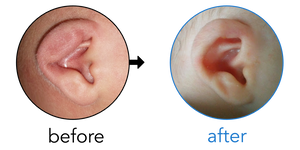 Before-and-after EarBuddies Lop Ear result; started within the first month – Laura & her Son George
