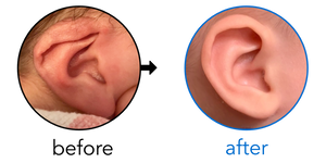 Before-and-after EarBuddies Lop Ear result; started within the first month – Andrea & her son