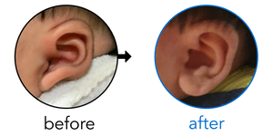 Before-and-after EarBuddies Stick-Out Lobe result; started at 3–6 months – Rhea & her Daughter Maisie Rose