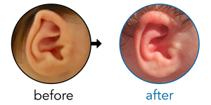 Before-and-after EarBuddies Folded-Over Helical Rim result; started at 1–3 months – Jessica L