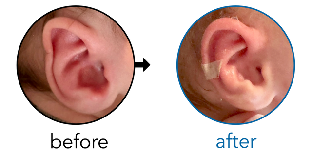 Before-and-after EarBuddies Folded-Over Helical Rim result; started at 1–3 months – Jenna