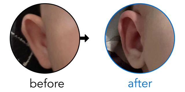 Before-and-after EarBuddies Stick-Out Ears result; started at 1–3 months – Kelly S