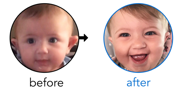 Before-and-after EarBuddies Stick-Out Ears result; started at 3–6 months – Simone S