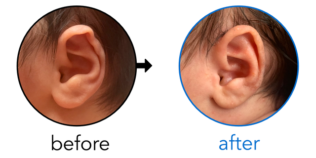 Before-and-after EarBuddies Rim Kink result; started within the first month – Luise & her son Zachary